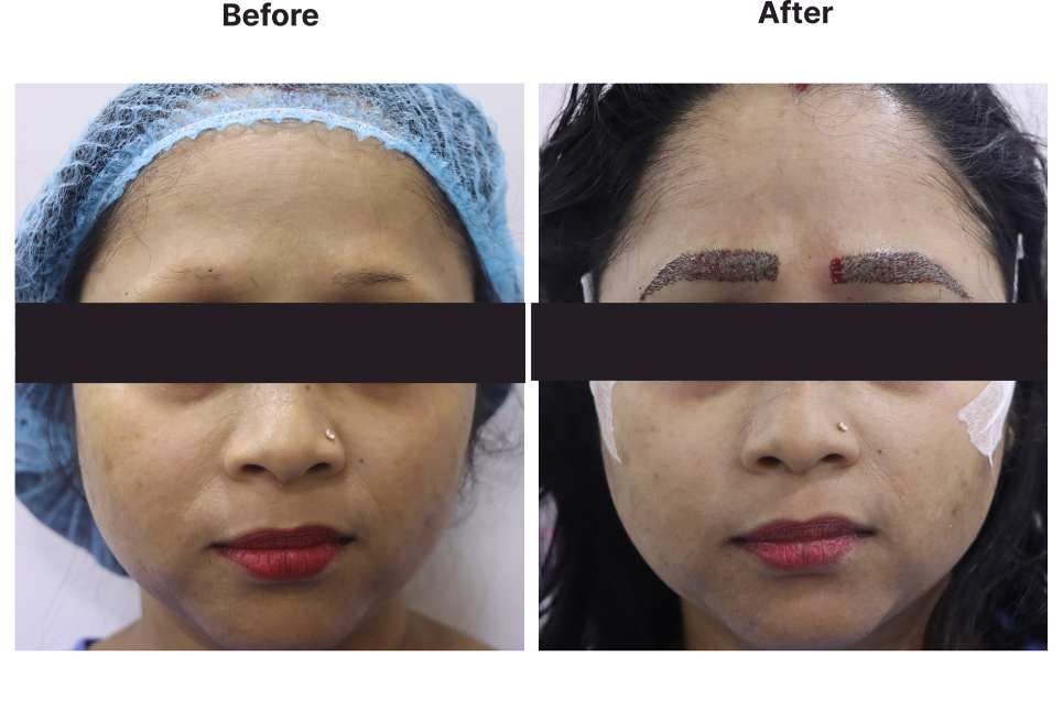 Hair Transplant result KOQ10